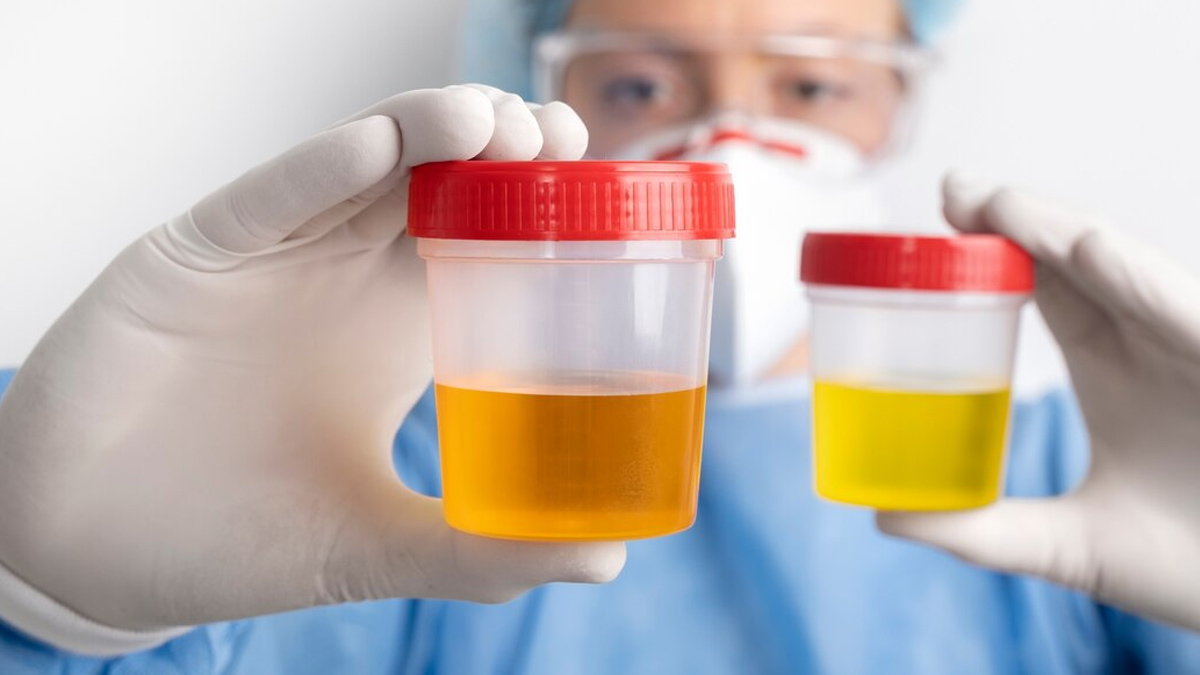urine colour indicates health issue