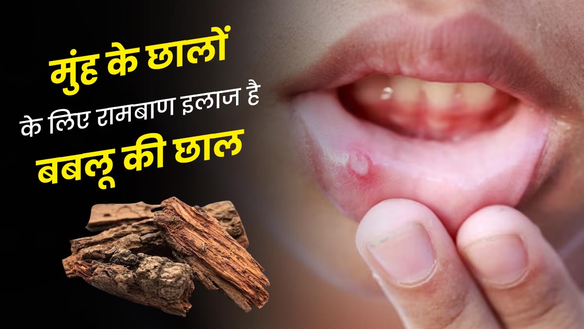 मुंह के छालों का रामबाण इलाज है बबूल की छाल, जानें इस्तेमाल का तरीका 