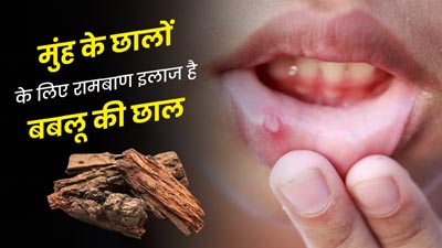 मुंह के छालों का रामबाण इलाज है बबूल की छाल, जानें इस्तेमाल का तरीका 