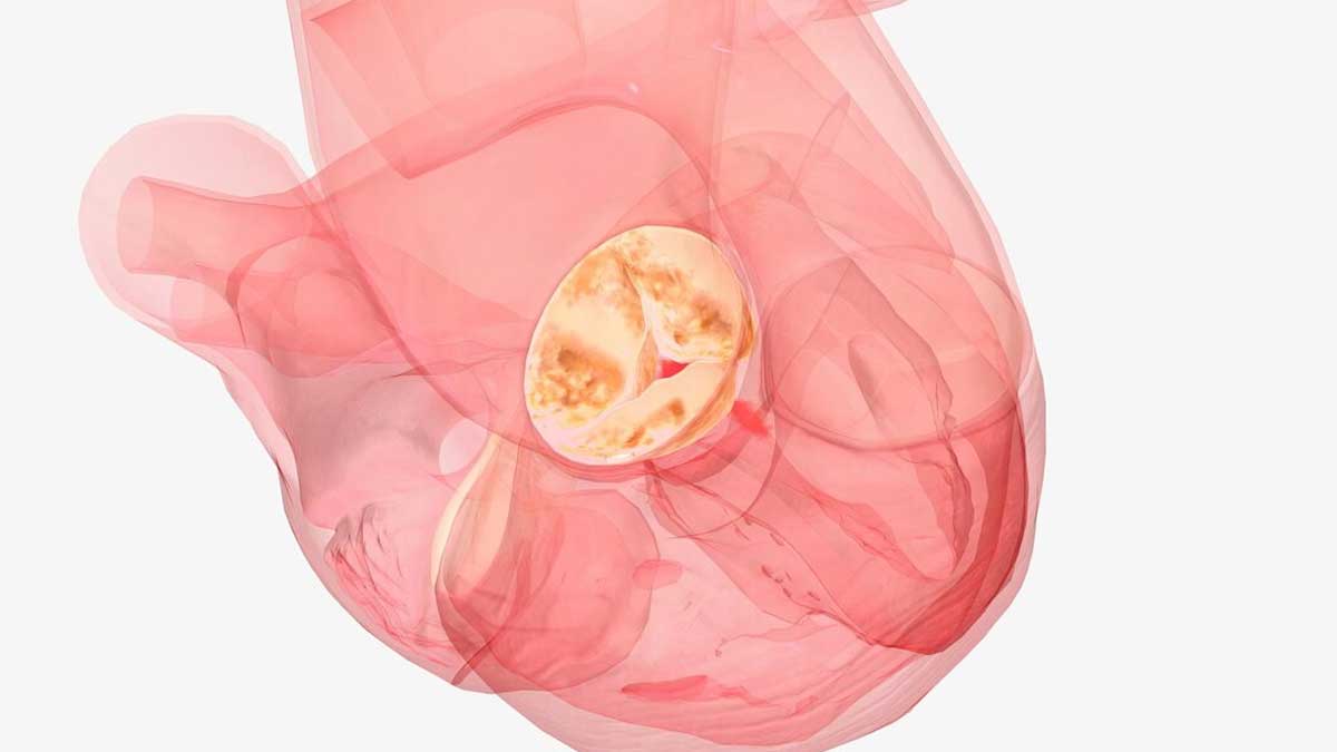 This Condition Causes Leakage From Valve: Expert Explains Aortic Regurgitation, Its Symptoms And Causes 