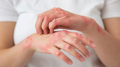 Essential Oils For Psoriasis: Expert Explains Role Of Essential Oils For Managing Psoriasis Symptoms