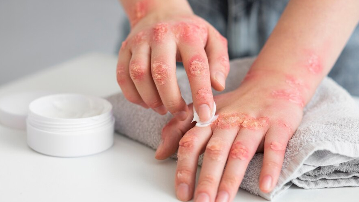 Side Effects Of Eating Psoriasis In Hindi