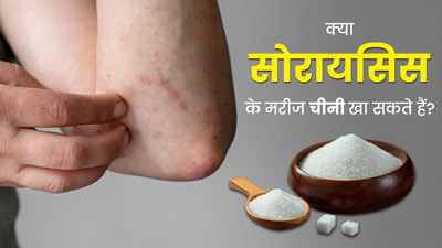 Psoriasis: क्या सोरायसिस के मरीज चीनी खा सकते हैं? एक्सपर्ट से जानें इसके नुकसान
