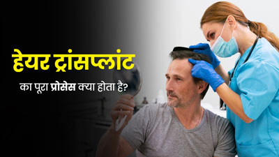 Hair Transplant Procedure : हेयर ट्रांसप्लांट का पूरा प्रोसेस क्या होता है? डॉक्टर से जानें इसके स्टेप्स