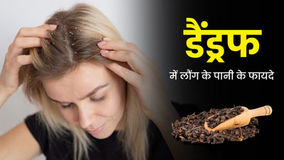 डैंड्रफ से छुटकारा पाने के लिए ऐसे करें लौंग के पानी का इस्तेमाल, दूर होगी परेशानी