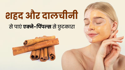 एक्ने-पिंपल्स से छुटकारा दिलाते हैं शहद और दालचीनी, इस तरह प्रयोग करने से जल्द दूर होगी समस्या