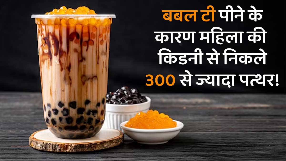 पानी की जगह रोज Bubble Tea पीती थी महिला, पेट दर्द के बाद जांच कराने पर किडनी से निकले 300 से ज्यादा पत्थर 