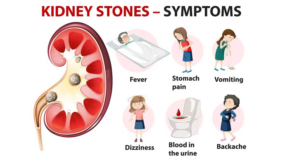 300 Kidney Stones Found In Woman Who Drinks Bubble Tea Instead Of Water