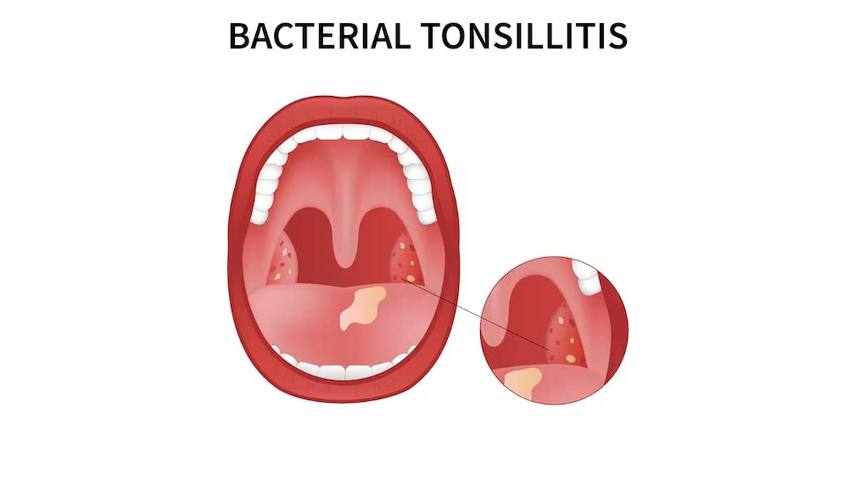 Having painful Tonsilloliths? Causes, Symptoms And Remedies To Get Rid Of It 