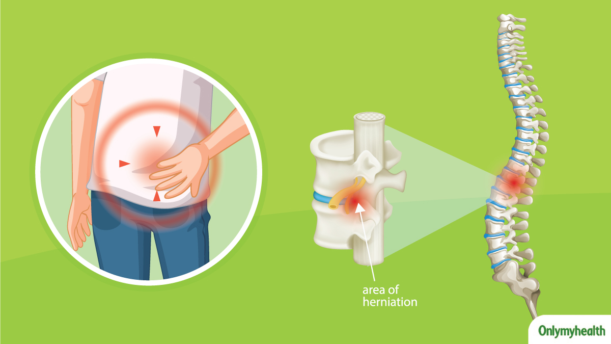 Spinal Chordoma in 12-year-old