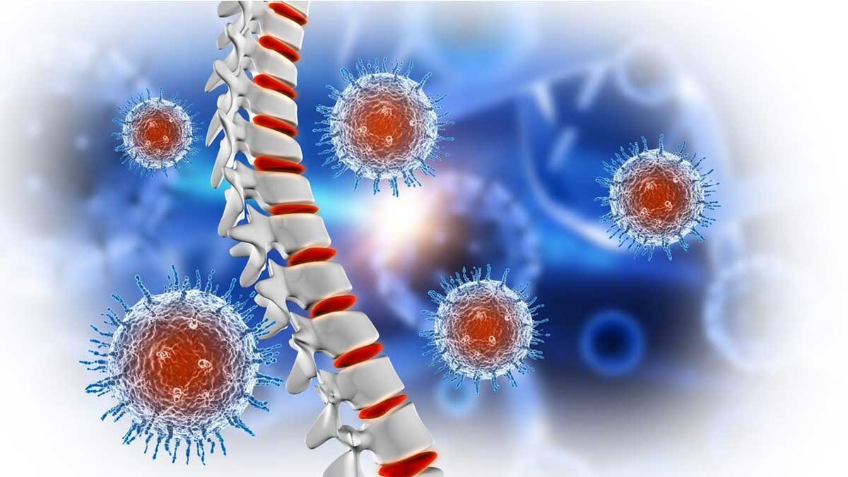 Osteosarcoma: What Are The Red Flags For Early Diagnosis?