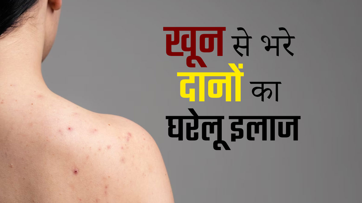 त्वचा पर खून से भरे दानों का इलाज कैसे करें? जानें 5 घरेलू उपाय 