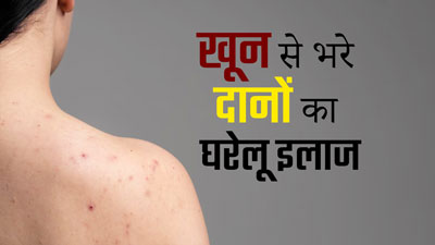 त्वचा पर खून से भरे दानों का इलाज कैसे करें? जानें 5 घरेलू उपाय 