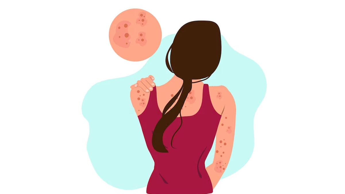 blood filled pimples