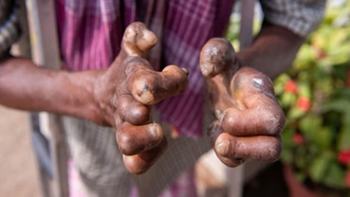 As Odisha Government Declares Leprosy A Reportable Disease, Expert Shares Preventive Measures