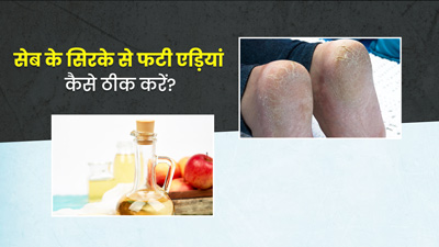 सेब के सिरके से करें फटी एड़ियों का इलाज, जानें कैसे करें इस्तमाल