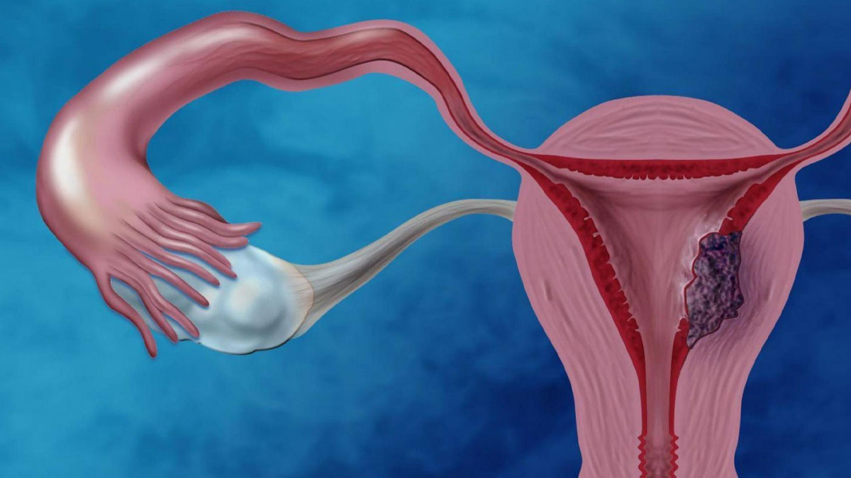 Endometrial-Cancer-Ke-Lakshan