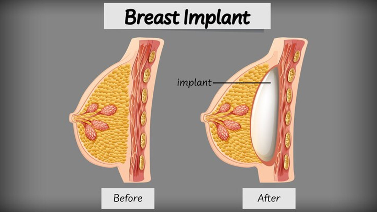 Plastic Surgery Myth #8: Implants affect breast feeding