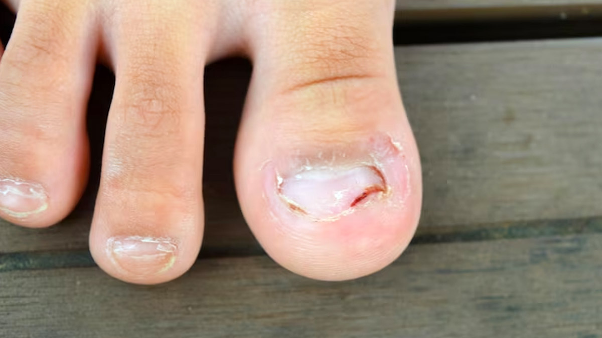 Toenail Fungus Onychomycosis Or Tinea Unguium OC Foot And Ankle Clinic ...