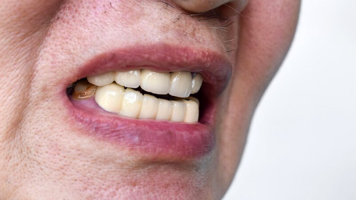 Tooth Erosion: Know Its Signs And Prevention | OnlyMyHealth