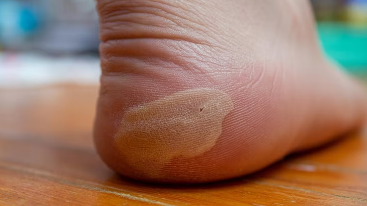 Diabetic Foot Symptoms: 6 Signs You Should Not Ignore