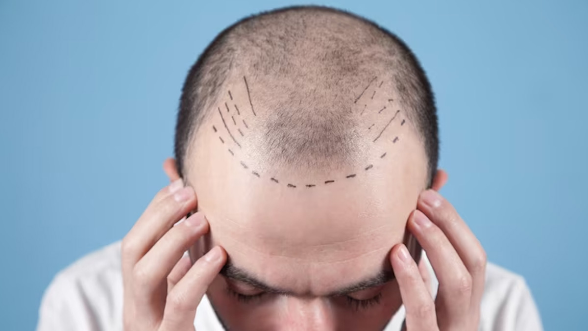 Receding Hairline: Stages, Diagnosis And Treatment Options