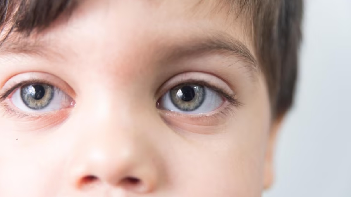 Warning Signs Of Glaucoma In Children & Ways To Prevent It, Expert Weighs In