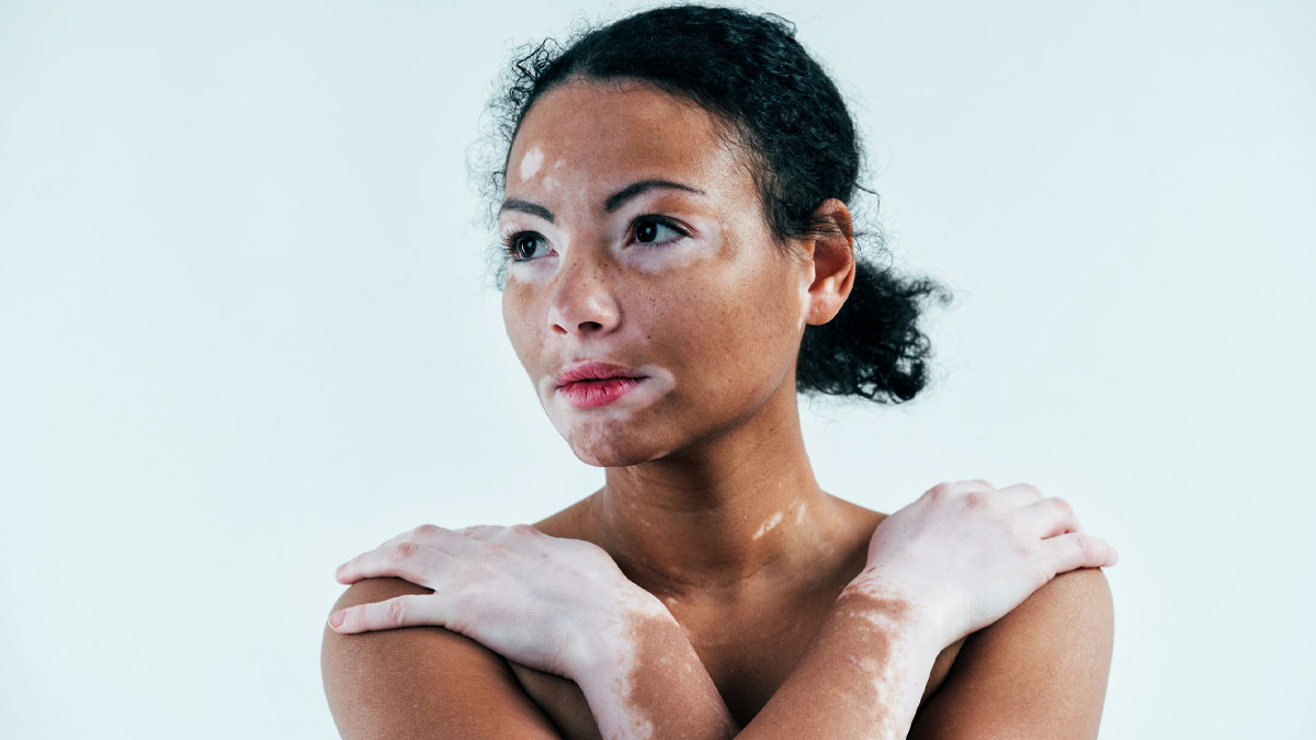 what causes vitiligo skin disease in hindi