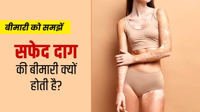 त्वचा पर सफेद दाग की बीमारी (विटिलिगो) क्यों होती है? आसान भाषा में डॉक्टर से समझें इसके कारण