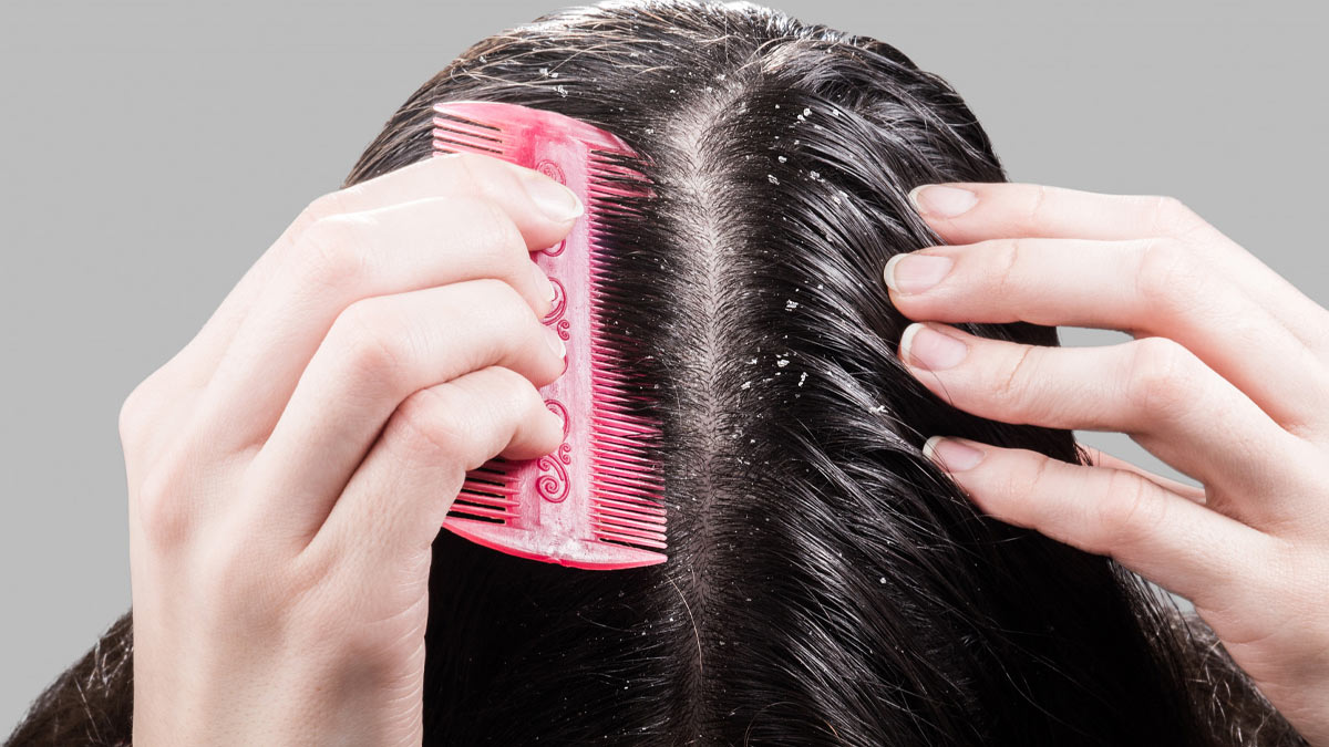 How To Use Camphor For Dandruff in hindi