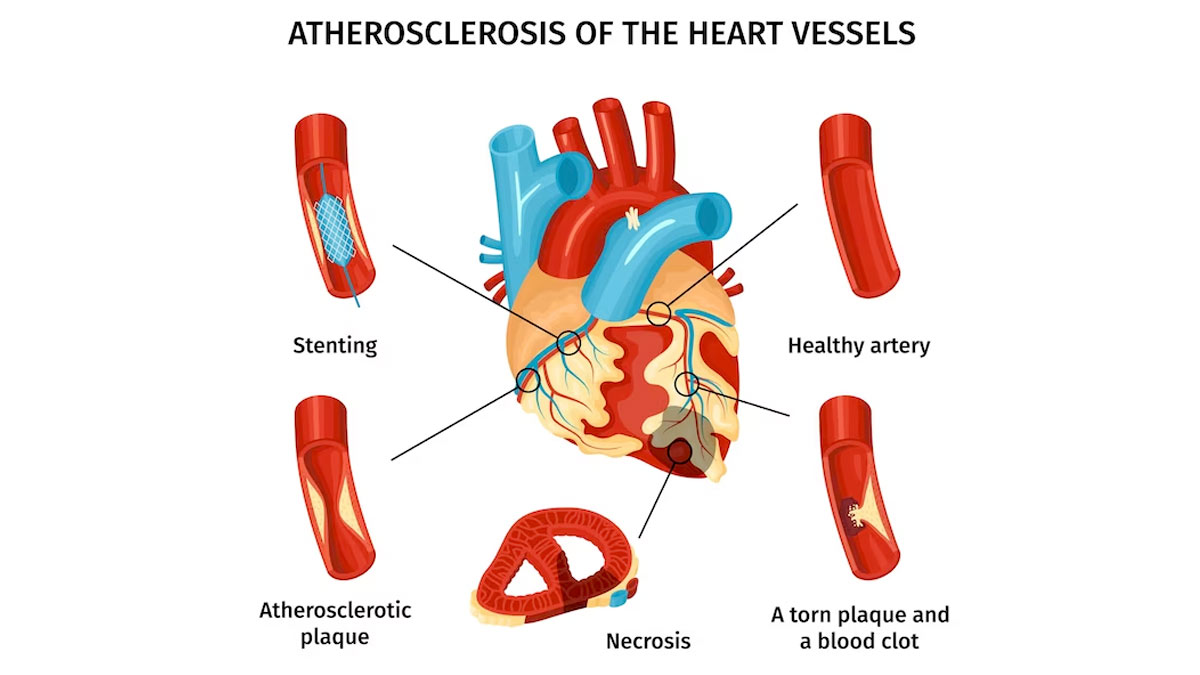 peripheral-arterial-disease-symptoms-self-care-measures-treatments