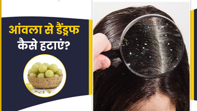 डैंड्रफ को दूर कर सकता है आंवला, इन 3 तरीकों से करें इस्तेमाल