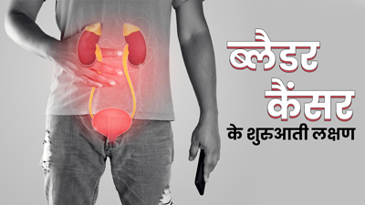 ब्लैडर कैंसर की शुरुआत में दिखते हैं ये 5 लक्षण, जानें कैसे करें बचाव