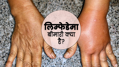 हाथी की तरह सूज जाते हैं शरीर के कई हिस्से, जानें क्या है लिम्फेडेमा बीमारी और इसके लक्षण