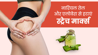 स्ट्रेच मार्क्स हटाने के लिए नारियल तेल में मिलाकर लगाएं एलोवेरा