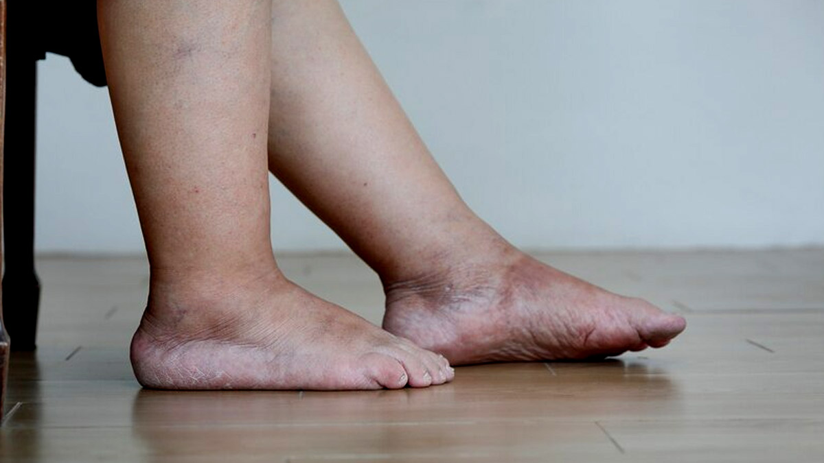 Liver Failure: ​Watch Out! Cracked Heels, Itchy Feet Signal Liver