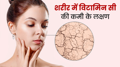 विटामिन सी की कमी होने पर शरीर में दिखते हैं ये 5 लक्षण, न करें नजरअंदाज