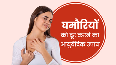 घमौरियां दूर करने के लिए अपनाएं ये 5 आयुर्वेदिक उपाय, जल्द मिलेगा आराम 