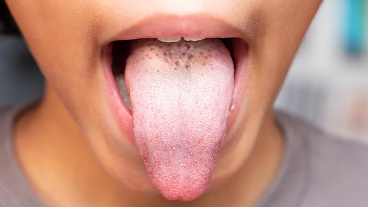 White store tongue thrush