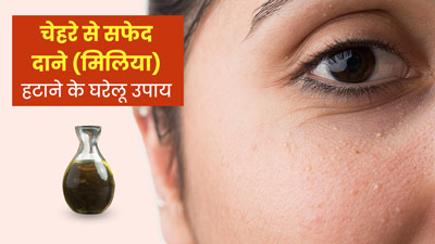 चेहरे पर सफेद दानों (मिलिया) से हैं परेशान? इन 5 घरेलू उपायों से मिलेगा छुटकारा