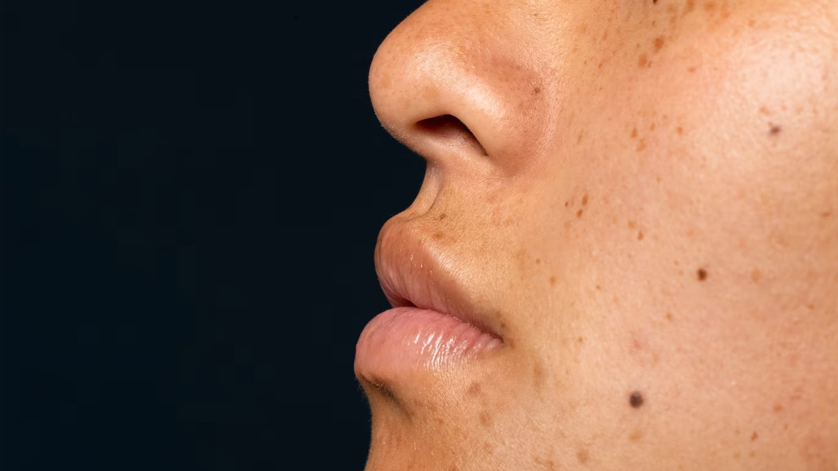 Sandalwood Face Pack For Dark Spots In Hindi