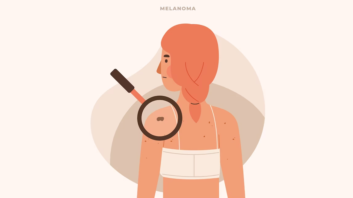 Abnormal Mole Or Skin Growth? Experts Explains Detection And Types Of Melanoma