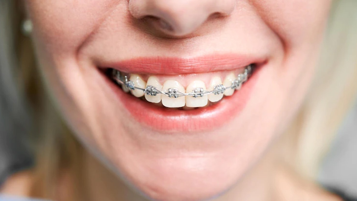 Risks of Dental Braces