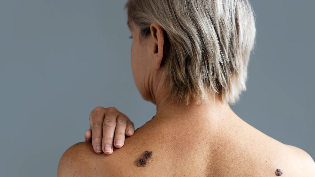 A Tattoo That Can Help Discover Early Cancers - Personalized Hemonc