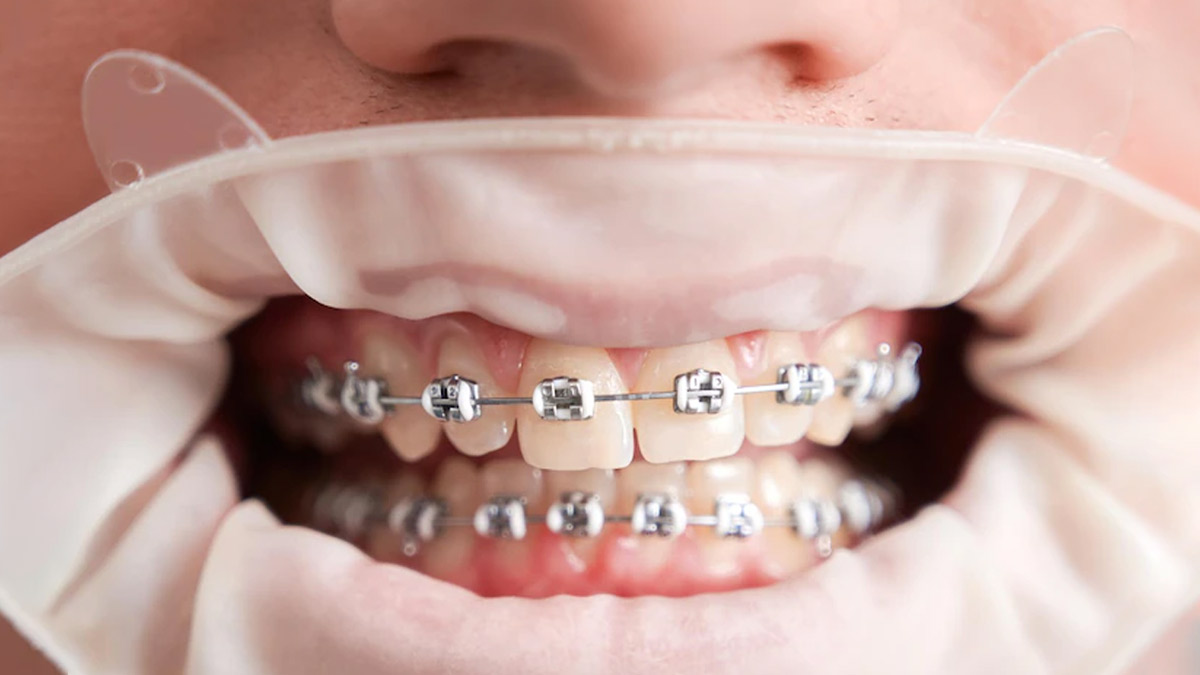 Invisible Braces Vs. Metal Braces: Which Is Better And Why