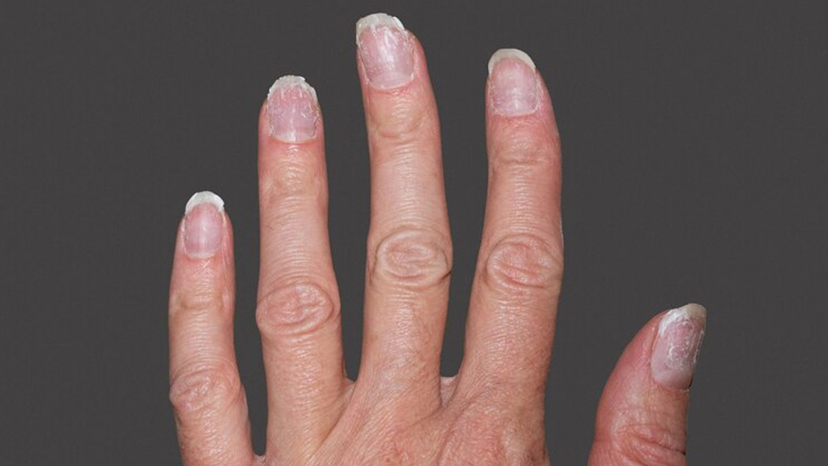 Fingernail Problems That Should Not Be Ignored