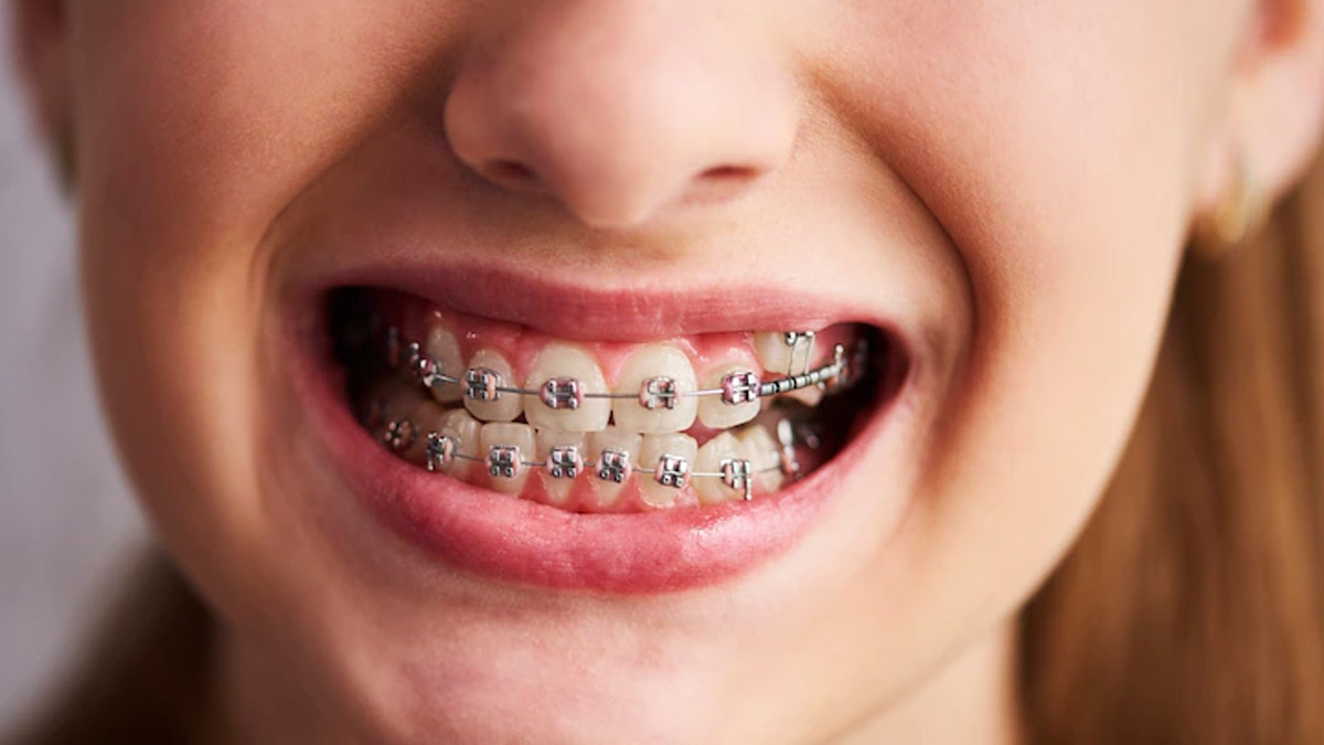 Can Braces Cause Teeth Staining, Dentist Answers