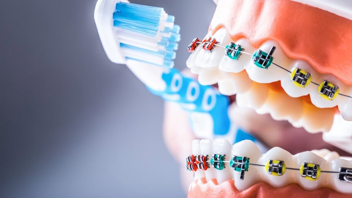 Maintaining Good Oral Hygiene With Braces Is Challenging, Here's