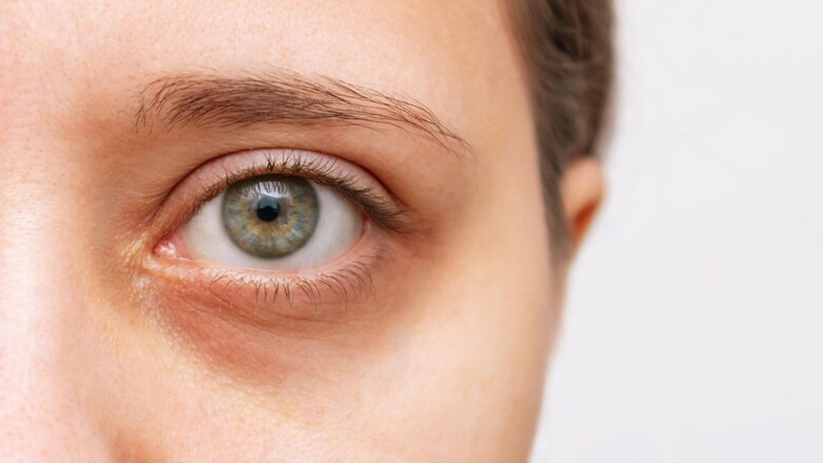 Sunken Eyes - Causes, Symptoms And Remedies | OnlyMyHealth