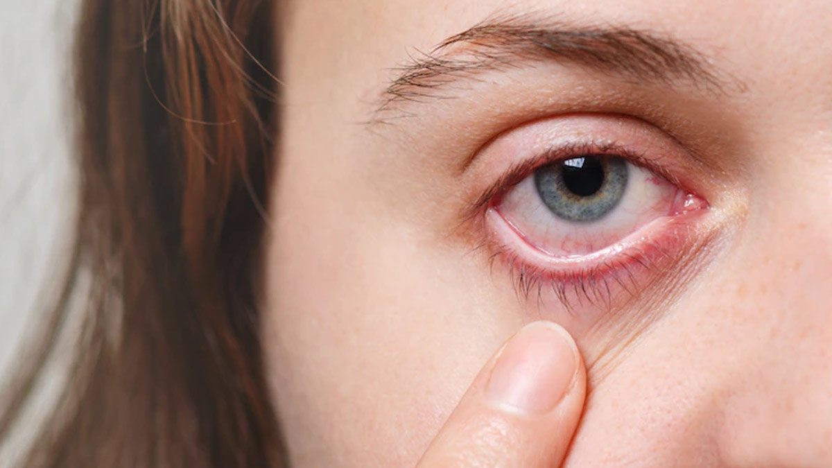 Sunken Eyes - Causes, Symptoms And Remedies